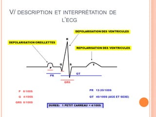 V/ DESCRIPTION

ET INTERPRÉTATION DE
L’ECG

 