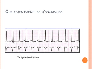 QUELQUES

EXEMPLES D’ANOMALIES

Tachycardie sinusale

 