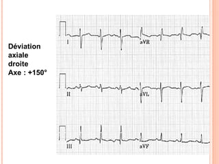 Déviation
axiale
droite
Axe : +150°

 