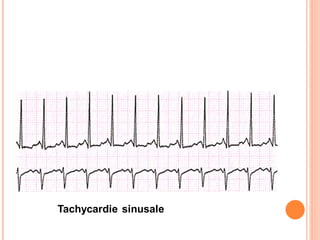 Tachycardie sinusale

 