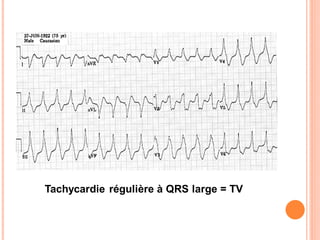 Tachycardie régulière à QRS large = TV

 