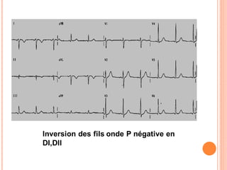 Inversion des fils onde P négative en
DI,DII

 