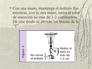    Con una mano, mantenga el émbolo fijo
    mientras, con la otra mano, retira el tubo
    de inserción no más de 1-2 centímetros.
    De este modo se abrirán los brazos de la
    “T”.
 