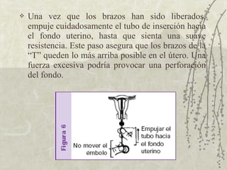    Una vez que los brazos han sido liberados,
    empuje cuidadosamente el tubo de inserción hacia
    el fondo uterino, hasta que sienta una suave
    resistencia. Este paso asegura que los brazos de la
    “T” queden lo más arriba posible en el útero. Una
    fuerza excesiva podría provocar una perforación
    del fondo.
 