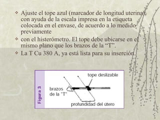    Ajuste el tope azul (marcador de longitud uterina),
    con ayuda de la escala impresa en la etiqueta
    colocada en el envase, de acuerdo a lo medido
    previamente
   con el histerómetro. El tope debe ubicarse en el
    mismo plano que los brazos de la “T”.
   La T Cu 380 A, ya está lista para su inserción.
 