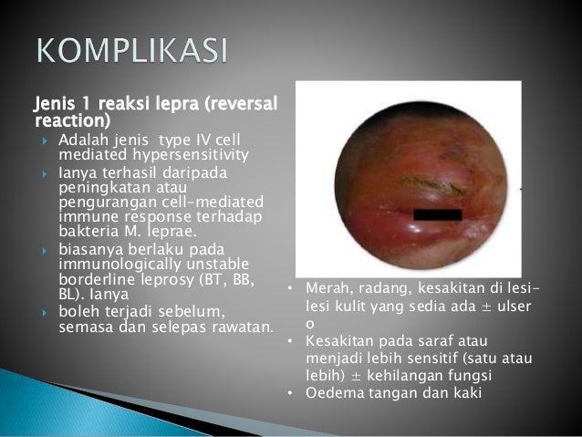 Apa itu kusta (1)