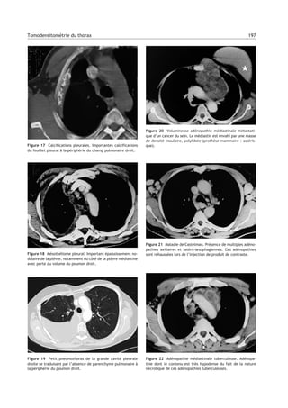 Figure 17 Calcifications pleurales. Importantes calcifications
du feuillet pleural à la périphérie du champ pulmonaire droit.
Figure 18 Mésothéliome pleural. Important épaississement no-
dulaire de la plèvre, notamment du côté de la plèvre médiastine
avec perte du volume du poumon droit.
Figure 19 Petit pneumothorax de la grande cavité pleurale
droite se traduisant par l’absence de parenchyme pulmonaire à
la périphérie du poumon droit.
Figure 20 Volumineuse adénopathie médiastinale métastati-
que d’un cancer du sein. Le médiastin est envahi par une masse
de densité tissulaire, polylobée (prothèse mammaire : astéris-
que).
Figure 21 Maladie de Castelman. Présence de multiples adéno-
pathies axillaires et latéro-œsophagiennes. Ces adénopathies
sont rehaussées lors de l’injection de produit de contraste.
Figure 22 Adénopathie médiastinale tuberculeuse. Adénopa-
thie dont le contenu est très hypodense du fait de la nature
nécrotique de ces adénopathies tuberculeuses.
197Tomodensitométrie du thorax
 