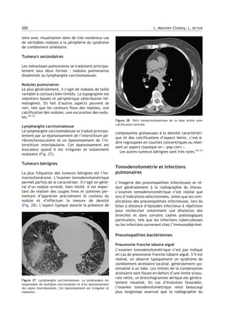 laire avec visualisation dans de très nombreux cas
de véritables nodules à la périphérie du syndrome
de comblement alvéolaire.
Tumeurs secondaires
Les métastases pulmonaires se traduisent principa-
lement sous deux formes : nodules pulmonaires
disséminés ou lymphangite carcinomateuse.
Nodules pulmonaires
Le plus généralement, il s’agit de nodules de taille
variable à contours bien limités. La topographie est
volontiers basale et périphérique (distribution hé-
matogène). En fait d’autres aspects peuvent se
voir, tels que les contours flous des nodules, une
calcification des nodules, une excavation des nodu-
les.29,53
Lymphangite carcinomateuse
La lymphangite carcinomateuse se traduit principa-
lement par un épaississement de l’interstitium pé-
ribronchovasculaire et un épaississement de l’in-
terstitium interlobulaire. Cet épaississement est
évocateur quand il est irrégulier et notamment
nodulaire (Fig. 27).
Tumeurs bénignes
La plus fréquente des tumeurs bénignes est l’ha-
martochondrome. L’examen tomodensitométrique
permet parfois de le caractériser. Il s’agit en géné-
ral d’un nodule arrondi, bien limité. Il est impor-
tant de réaliser des coupes fines et jointives per-
mettant d’apprécier précisément le contenu du
nodule et d’effectuer la mesure de densité
(Fig. 28). L’aspect typique associe la présence de
composantes graisseuses à la densité caractéristi-
que et des calcifications d’aspect bénin, c’est-à-
dire regroupées en couches concentriques ou réali-
sant un aspect classique en « pop corn ».
Les autres tumeurs bénignes sont très rares.69,74
Tomodensitométrie et infections
pulmonaires
L’imagerie des pneumopathies infectieuses se ré-
duit généralement à la radiographie du thorax.
L’examen tomodensitométrique n’est réalisé que
lors d’indications sélectionnées, telles que les com-
plications des pneumopathies infectieuses, lors du
bilan à distance d’épisodes infectieux à répétition
pour rechercher notamment une dilatation des
bronches et dans certains cadres pathologiques
particuliers, tels que les infections tuberculeuses
ou les infections survenant chez l’immunodéprimé.
Pneumopathies bactériennes
Pneumonie franche lobaire aiguë
L’examen tomodensitométrique n’est pas indiqué
en cas de pneumonie franche lobaire aiguë. S’il est
réalisé, on observe typiquement un syndrome de
comblement alvéolaire localisé, généralement sys-
tématisé à un lobe. Les limites de la condensation
alvéolaire sont floues en dehors d’une limite scissu-
rale nette, un bronchogramme aérique est généra-
lement visualisé. En cas d’évolution favorable,
l’examen tomodensitométrique reste beaucoup
plus longtemps anormal que la radiographie du
Figure 27 Lymphangite carcinomateuse. La lymphangite est
responsable de multiples micronodules et d’un épaississement
des septa interlobulaires. Cet épaississement est irrégulier et
nodulaire.
Figure 28 Petit hamartochondrome de la base droite avec
calcification centrale.
200 L. Monnier-Cholley, L. Arrivé
 