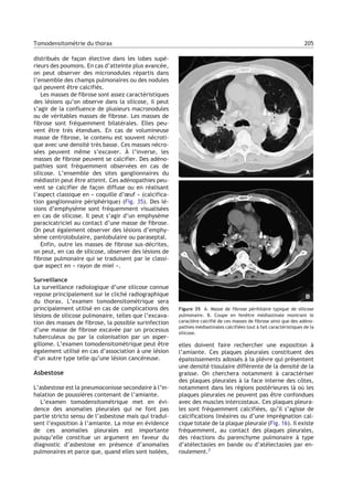 distribués de façon élective dans les lobes supé-
rieurs des poumons. En cas d’atteinte plus avancée,
on peut observer des micronodules répartis dans
l’ensemble des champs pulmonaires ou des nodules
qui peuvent être calcifiés.
Les masses de fibrose sont assez caractéristiques
des lésions qu’on observe dans la silicose, il peut
s’agir de la confluence de plusieurs macronodules
ou de véritables masses de fibrose. Les masses de
fibrose sont fréquemment bilatérales. Elles peu-
vent être très étendues. En cas de volumineuse
masse de fibrose, le contenu est souvent nécroti-
que avec une densité très basse. Ces masses nécro-
sées peuvent même s’excaver. À l’inverse, les
masses de fibrose peuvent se calcifier. Des adéno-
pathies sont fréquemment observées en cas de
silicose. L’ensemble des sites ganglionnaires du
médiastin peut être atteint. Ces adénopathies peu-
vent se calcifier de façon diffuse ou en réalisant
l’aspect classique en « coquille d’œuf » (calcifica-
tion ganglionnaire périphérique) (Fig. 35). Des lé-
sions d’emphysème sont fréquemment visualisées
en cas de silicose. Il peut s’agir d’un emphysème
paracicatriciel au contact d’une masse de fibrose.
On peut également observer des lésions d’emphy-
sème centrolobulaire, panlobulaire ou paraseptal.
Enfin, outre les masses de fibrose sus-décrites,
on peut, en cas de silicose, observer des lésions de
fibrose pulmonaire qui se traduisent par le classi-
que aspect en « rayon de miel ».
Surveillance
La surveillance radiologique d’une silicose connue
repose principalement sur le cliché radiographique
du thorax. L’examen tomodensitométrique sera
principalement utilisé en cas de complications des
lésions de silicose pulmonaire, telles que l’excava-
tion des masses de fibrose, la possible surinfection
d’une masse de fibrose excavée par un processus
tuberculeux ou par la colonisation par un asper-
gillome. L’examen tomodensitométrique peut être
également utilisé en cas d’association à une lésion
d’un autre type telle qu’une lésion cancéreuse.
Asbestose
L’asbestose est la pneumoconiose secondaire à l’in-
halation de poussières contenant de l’amiante.
L’examen tomodensitométrique met en évi-
dence des anomalies pleurales qui ne font pas
partie stricto sensu de l’asbestose mais qui tradui-
sent l’exposition à l’amiante. La mise en évidence
de ces anomalies pleurales est importante
puisqu’elle constitue un argument en faveur du
diagnostic d’asbestose en présence d’anomalies
pulmonaires et parce que, quand elles sont isolées,
elles doivent faire rechercher une exposition à
l’amiante. Ces plaques pleurales constituent des
épaississements adossés à la plèvre qui présentent
une densité tissulaire différente de la densité de la
graisse. On cherchera notamment à caractériser
des plaques pleurales à la face interne des côtes,
notamment dans les régions postérieures là où les
plaques pleurales ne peuvent pas être confondues
avec des muscles intercostaux. Ces plaques pleura-
les sont fréquemment calcifiées, qu’il s’agisse de
calcifications linéaires ou d’une imprégnation cal-
cique totale de la plaque pleurale (Fig. 16). Il existe
fréquemment, au contact des plaques pleurales,
des réactions du parenchyme pulmonaire à type
d’atélectasies en bande ou d’atélectasies par en-
roulement.2
Figure 35 A. Masse de fibrose périhilaire typique de silicose
pulmonaire. B. Coupe en fenêtre médiastinale montrant le
caractère calcifié de ces masses de fibrose ainsi que des adéno-
pathies médiastinales calcifiées tout à fait caractéristiques de la
silicose.
205Tomodensitométrie du thorax
 