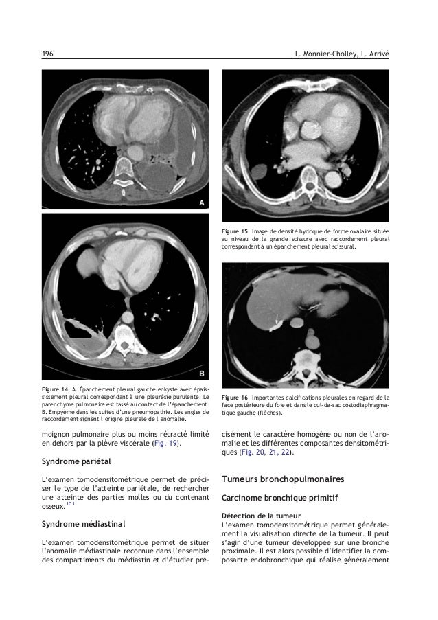 Tdm Thorax Tdm Thorax
