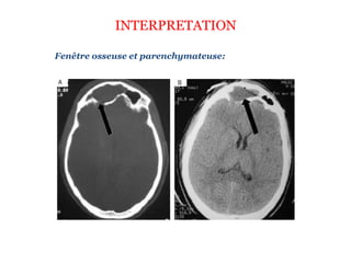 INTERPRETATION
Fenêtre osseuse et parenchymateuse:
 