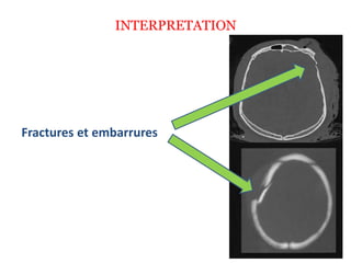 INTERPRETATION
Fractures et embarrures
 