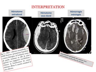 INTERPRETATION
Hématome
extradural
Hématome
sous dural
Hémorragie
méningée
 