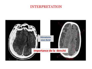 INTERPRETATION
Hématome
sous dural
Importance de la densité
 