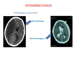 INTERPRETATION
- Pathologies vasculaires
AVC ischémique
AVC hémorragique
 