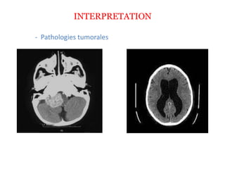 INTERPRETATION
- Pathologies tumorales
 