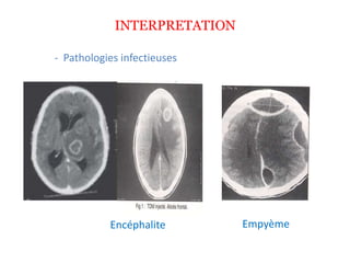 INTERPRETATION
- Pathologies infectieuses
Encéphalite Empyème
 