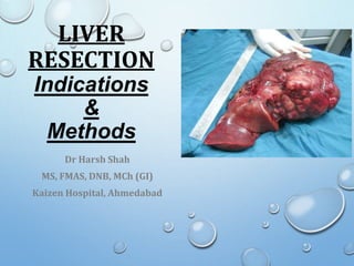 LIVER
RESECTION
Indications
&
Methods
Dr Harsh Shah
MS, FMAS, DNB, MCh (GI)
Kaizen Hospital, Ahmedabad
 