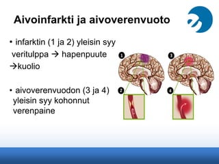 Aivoinfarkti ja aivoverenvuoto
• infarktin (1 ja 2) yleisin syy
veritulppa  hapenpuute
kuolio
• aivoverenvuodon (3 ja 4)
yleisin syy kohonnut
verenpaine
 