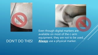 DON’T DO THIS!
Even though digital markers are
available on most of the c-arm
equipment, they are not to be used.
Always use a physical marker.
 