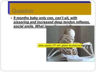  9 months baby only coo, can’t sit, with
sissoring and increased deep tendon reflexes,
social smile. What is ur diagnosis?
Question
early spastic CP with global developmental delay
 