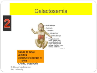 Dr Hussein Abdeldayem
Alex University
Galactosemia
Failure to thrive
vomiting
Galactusuria (sugar in
urine
AAuria, proteinuria
 