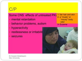 Dr Hussein Abdeldayem
Alex University
C/P
Some CNS effects of untreated PKU include:
 mental retardation
 behavior problems, autism
 hyperactivity
 restlessness or irritability
 seizures
1- fair hair and skin
2- a “musty” or
“mousy” body
odor
3- Eczema
 