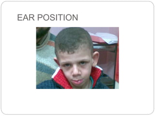 EAR POSITION
 