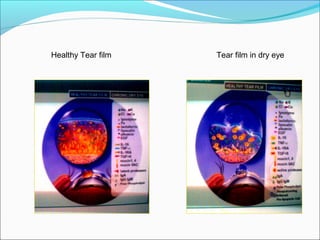 Healthy Tear film Tear film in dry eye
 