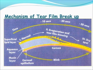 Mechanism of Tear Film Break up
 