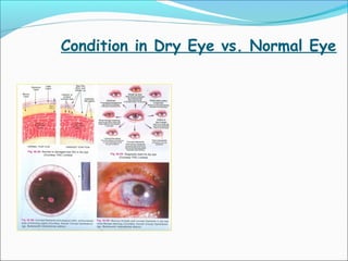 Condition in Dry Eye vs. Normal Eye
 