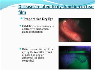 Diseases related to dysfunction in tear
film
Evaporative Dry Eye
Oil deficiency- secondary to
obstructive meibomian
gland dysfunction
Defective resurfacing of the
eye by the tear film (result
of poor blinking or
abnormal lid-globe
congruity)
 