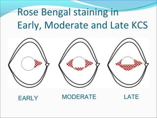 Rose Bengal staining in
Early, Moderate and Late KCS
EARLY MODERATE LATE
 