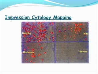 Impression Cytology Mapping
Healthy Mild
Moderate Severe
 