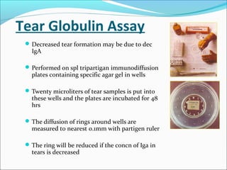 Tear Globulin Assay
Decreased tear formation may be due to dec
IgA
Performed on spl tripartigan immunodiffusion
plates containing specific agar gel in wells
Twenty microliters of tear samples is put into
these wells and the plates are incubated for 48
hrs
The diffusion of rings around wells are
measured to nearest 0.1mm with partigen ruler
The ring will be reduced if the concn of Iga in
tears is decreased
 