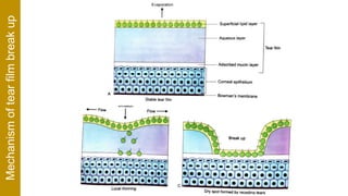 Mechanismoftearfilmbreakup
 