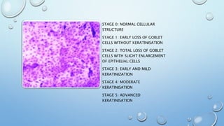 STAGE 0: NORMAL CELLULAR
STRUCTURE
STAGE 1: EARLY LOSS OF GOBLET
CELLS WITHOUT KERATINISATION
STAGE 2: TOTAL LOSS OF GOBLET
CELLS WITH SLIGHT ENLARGEMENT
OF EPITHELIAL CELLS
STAGE 3: EARLY AND MILD
KERATINIZATION
STAGE 4: MODERATE
KERATINISATION
STAGE 5: ADVANCED
KERATINISATION
 