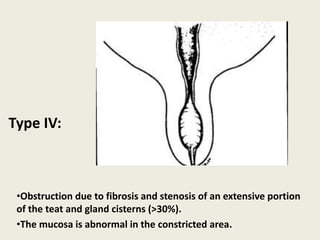 •Obstruction due to fibrosis and stenosis of an extensive portion
of the teat and gland cisterns (>30%).
•The mucosa is abnormal in the constricted area.
Type IV:
 
