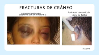 FRACTURAS DE CRÁNEO
Equimosis periorbital
(signo de "ojos de mapache")
Equimosis retroauricular
(signo de Battle)
ATLS. (2018)
 