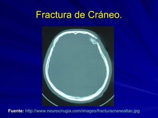 Fractura de Cráneo. Fuente:   http:// www.neurocirugia.com / images / fracturacranealtac.jpg   