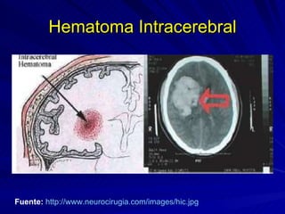 Hematoma Intracerebral Fuente:   http://www.neurocirugia.com/images/hic.jpg   