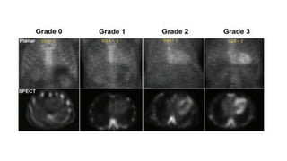 Pyp Scan Order Technetium-99m pyrophosphate scintigraphy (PYP) scan for.pptx