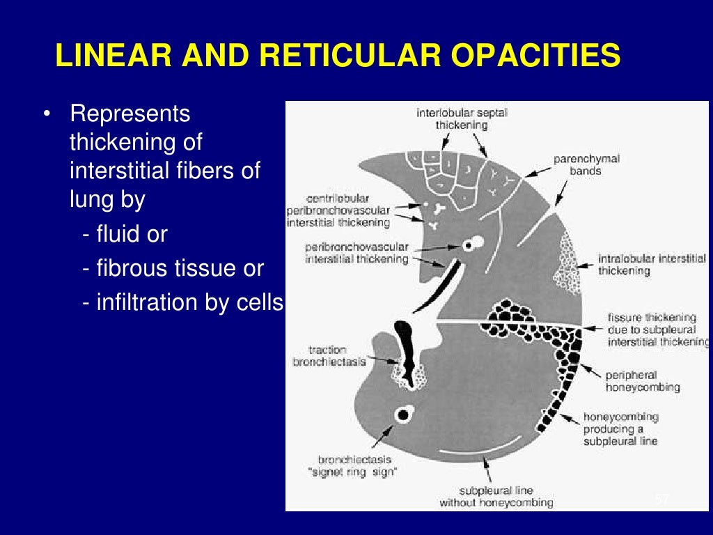 Technical aspect of hrct; normal lung anatomy & hrct findings of lung…