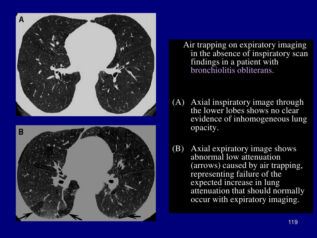 Technical aspect of hrct; normal lung anatomy & hrct findings of lung…