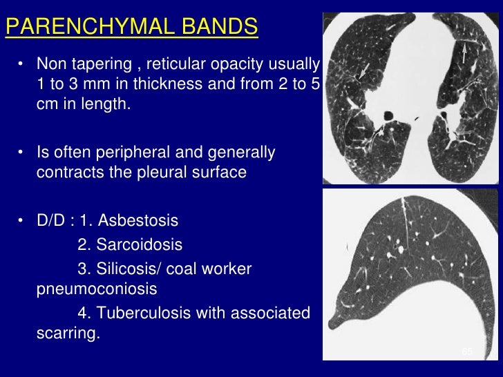 hrct findings subpleural thickening scarring fissure interstitial