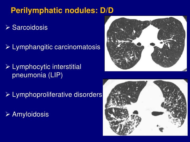 Centrilobular Nodules With Ground Glass Opacities In The Lungs Centrilobular Nodules With Ground Glass Opacities In The Lungs