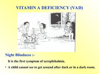 VITAMIN A DEFICIENCY (VAD)
Night Blindness :-
• It is the first symptom of xerophthalmia.
• A child cannot see to get around after dark or in a dark room.
 