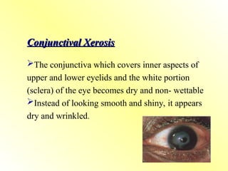Conjunctival Xerosis
Conjunctival Xerosis
The conjunctiva which covers inner aspects of
upper and lower eyelids and the white portion
(sclera) of the eye becomes dry and non- wettable
Instead of looking smooth and shiny, it appears
dry and wrinkled.
 