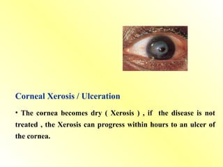 Corneal Xerosis / Ulceration
• The cornea becomes dry ( Xerosis ) , if the disease is not
treated , the Xerosis can progress within hours to an ulcer of
the cornea.
 