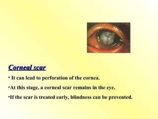 Corneal scar
Corneal scar
• It can lead to perforation of the cornea.
•At this stage, a corneal scar remains in the eye.
•If the scar is treated early, blindness can be prevented.
 